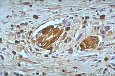 lung_cancer_intravasal03